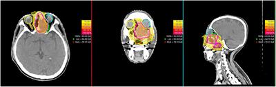 Particle Beam Radiation Therapy for Skull Base Sarcomas